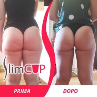 Coppette anticellulite slimcup coppette anticellulite slimcup Slimcup prima e dopo